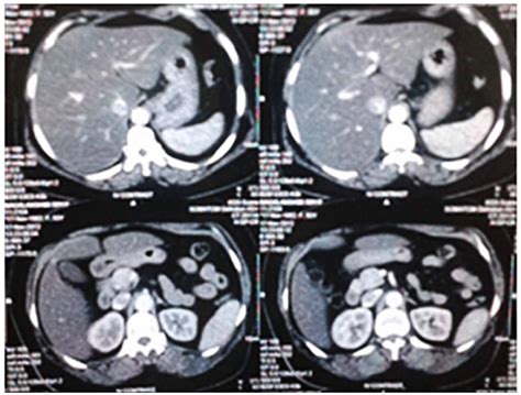 scanliver|liver scan definition.